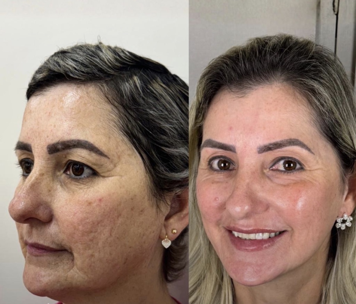 Antes e depois de tratamento conduzido pela Dra. Andressa Rada