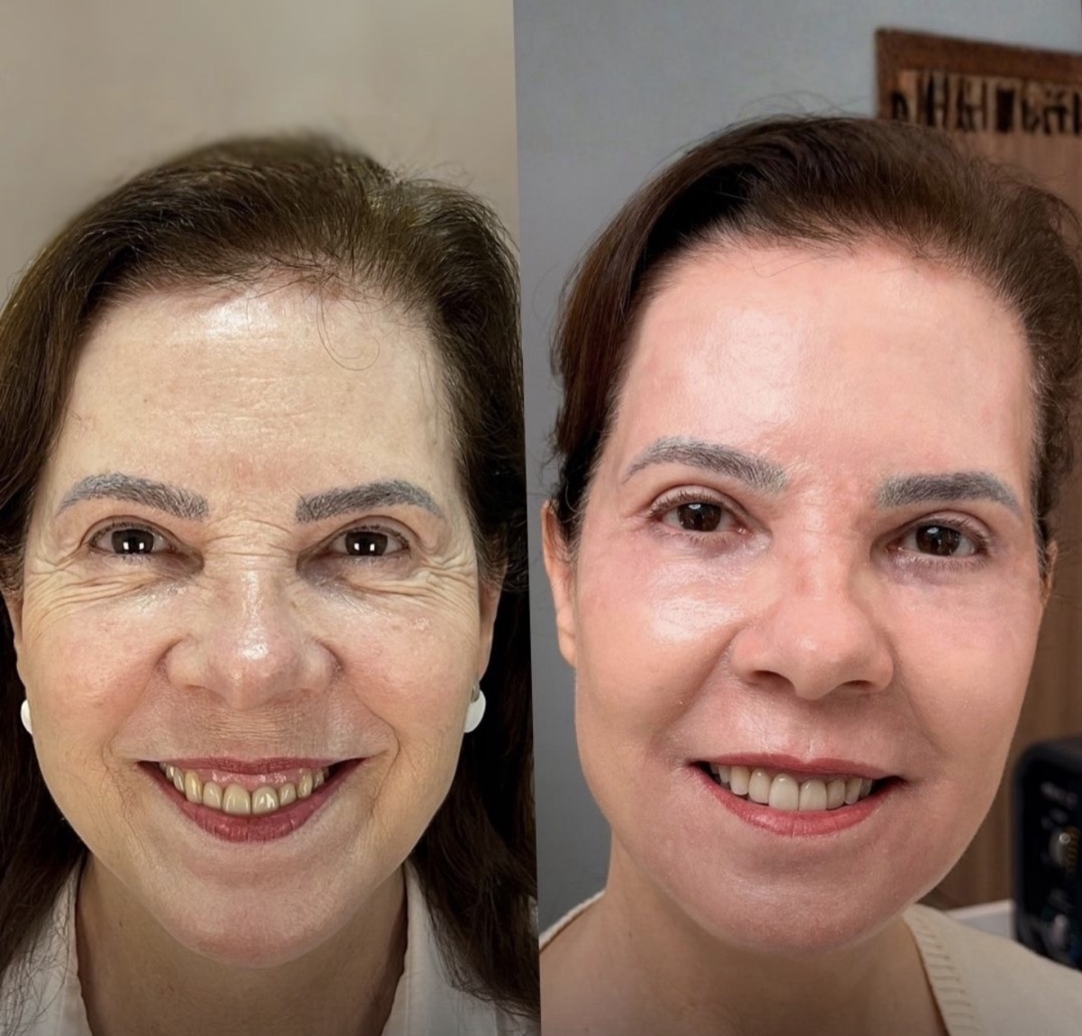 Antes e depois de tratamento facial conduzido pela Dra. Andressa Rada