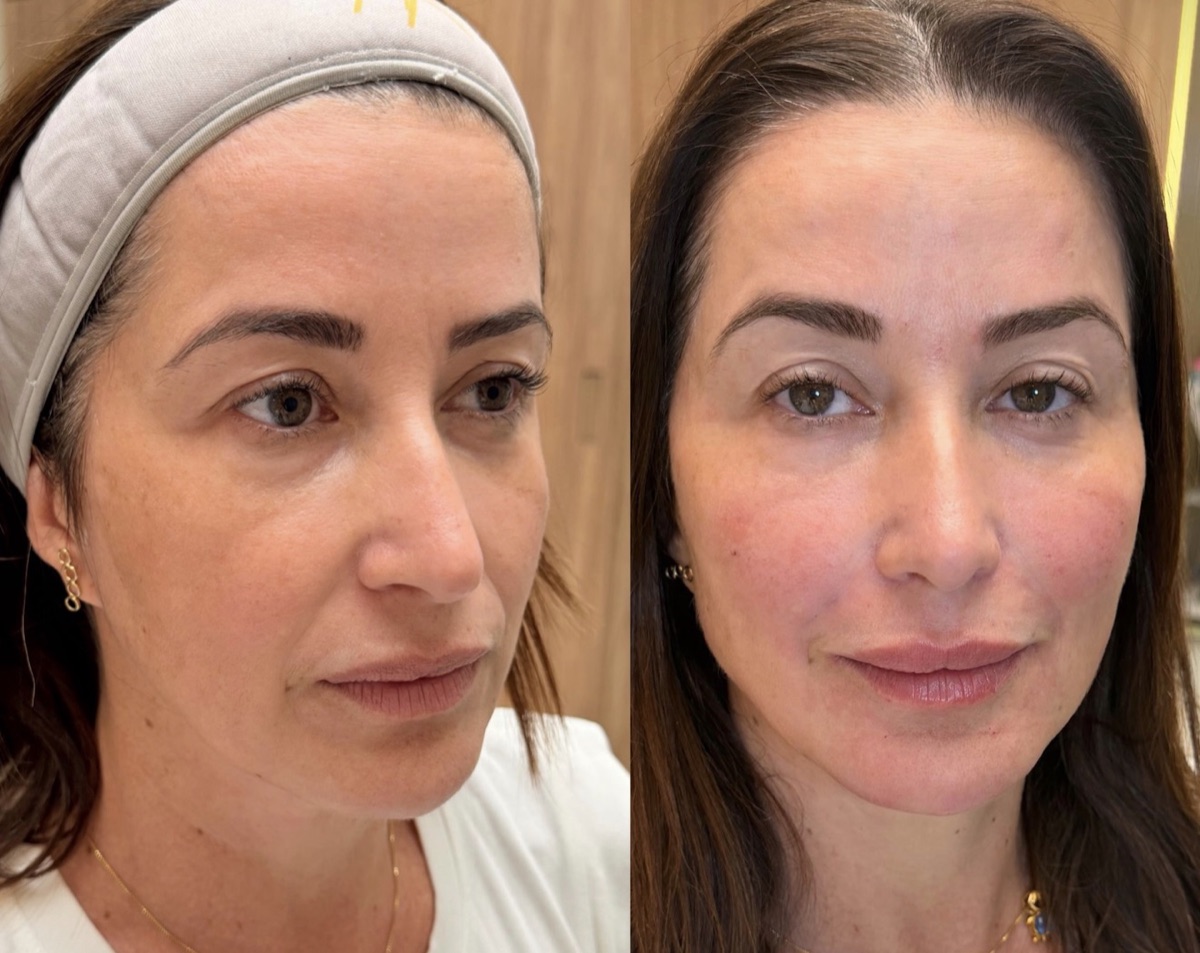 Antes e depois de rejuvenescimento facial conduzido pela Dra. Andressa Rada