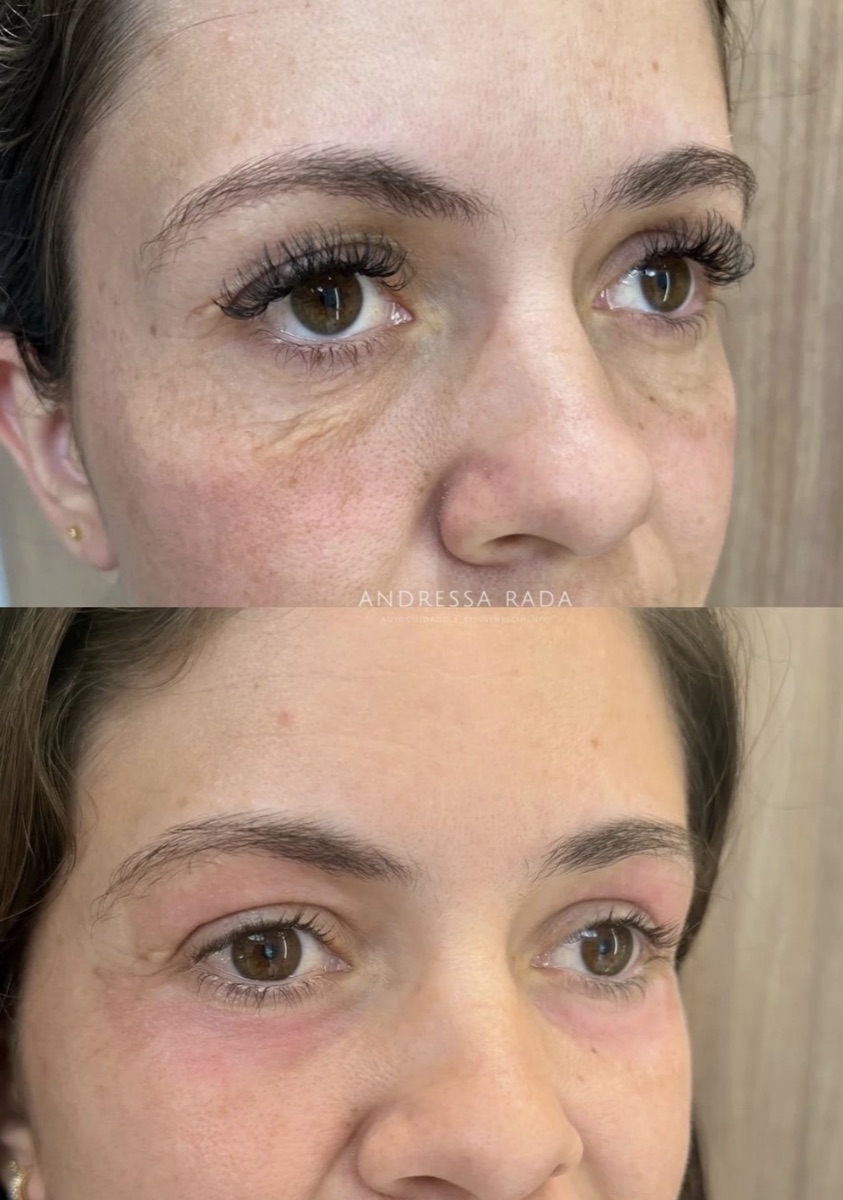 Antes e depois de qualidade de pele conduzido pela Dra. Andressa Rada